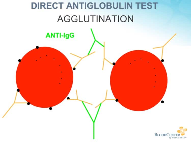 DAT procedure 4 - Anti-human globulin agglutinates coated RBCs