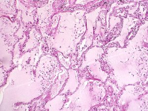 067 Preventing TRALI Featured Pulmonary Edema